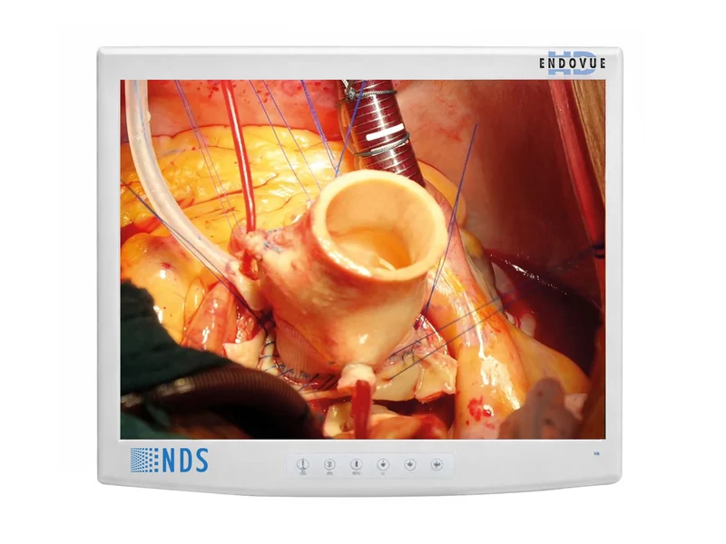 NDS EndoVue 19" BC-SX19-N1418 SXGA Value Surgical Endoscopy LCD Display Monitor