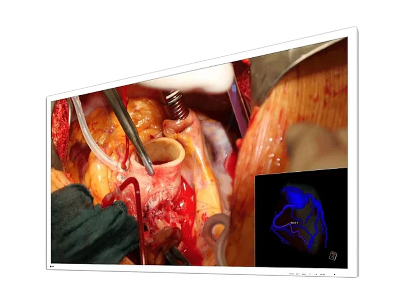Eizo CuratOR 58" UHD 4K LED Surgical Display (EX5841)